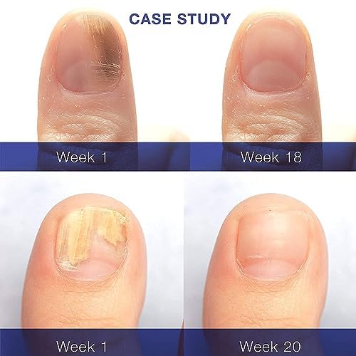 Dr. Luke Toenail Fungus Revitalizer Tough on Nails: Nail Fungus Refresher Liquid for Discolored Nails 1 oz (Packaging May Vary)