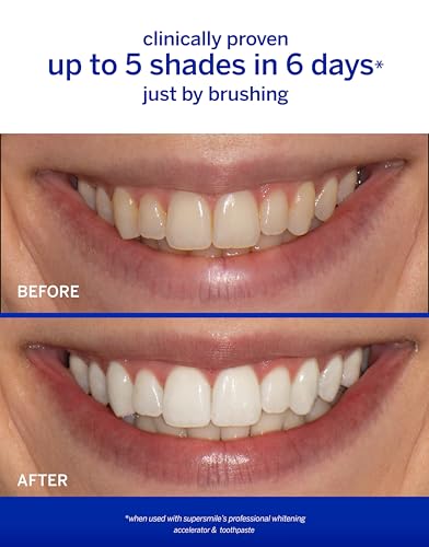 Supersmile Professional Whitening Toothpaste w/ Fluoride - Removes Stains & Whitens Teeth 6 Shades - Enamel Strengthening - No Sensitivity - Travel Size (Original Mint, 1.4 Oz)