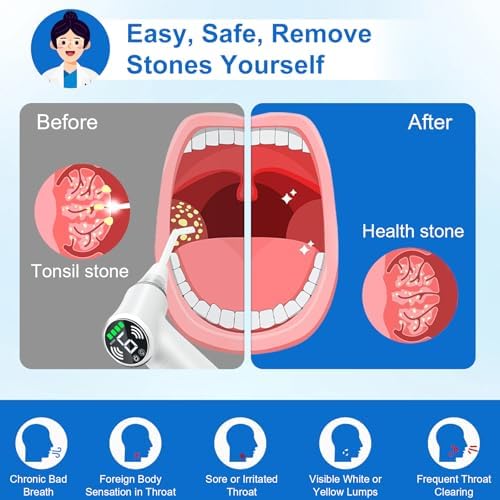 Tonsil Stone Remover Tool, Upgraded Electric Tonsil Stone Removal Kit - with Built-in LED Light & 6-Level Suction for Bad Breath Prevention, Oral Suction Device for Stone Removal