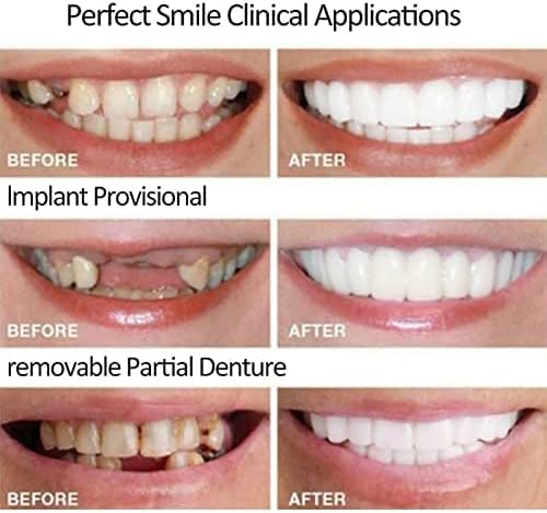 2 Pairs, Adjustable for Men and Women, Top and Bottom, Beautiful Smile
