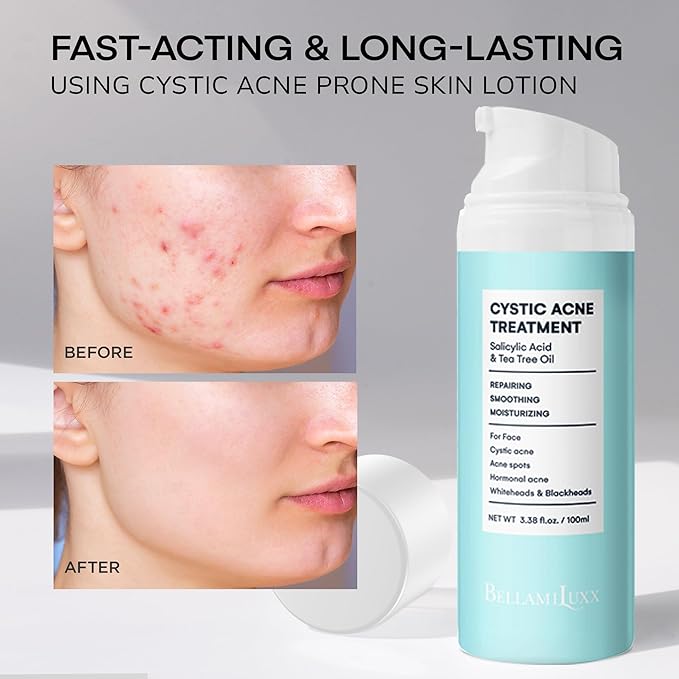 Cystic Acne Treatment for Face: Hormonal Acne Treatment Cream for Teens & Adults - Salicylic Acid & Tea Tree Oil Pimple Spot Remover - Anti-Acne Moisturizer Reduces Redness, Blemishes